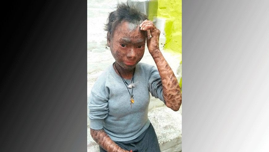 Expulsan de la escuela a una alumna que padece la enfermedad de la 'serpiente humana' y daba miedo a sus compañeros Expulsan de la escuela a una alumna que padece la enfermedad de la 'serpiente humana' y daba miedo a sus compañeros