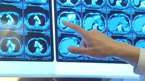 Frame 40.742397 de: El n&uacute;mero de casos de c&aacute;ncer registrados en Espa&ntilde;a en 2015 supera los estimados para 2020