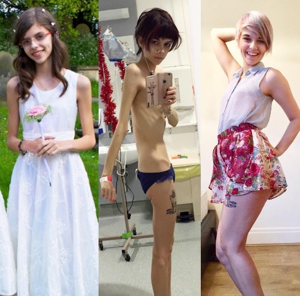 Una joven cuenta a través de Instagram cómo se ha recuperado de la anorexia Una joven cuenta a través de Instagram cómo se ha recuperado de la anorexia