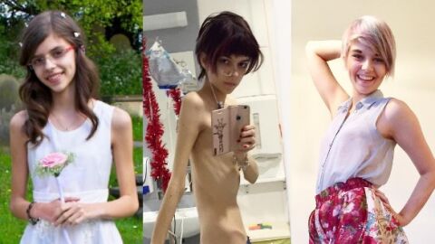La evoluci&oacute;n de la joven que sufr&iacute;a anorexia