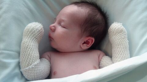 Beb&eacute; piel de mariposa