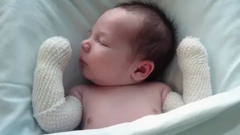 Bebé piel de mariposa Bebé piel de mariposa