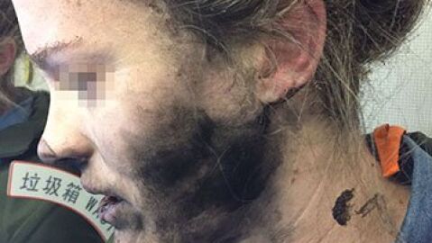 Mujer que sufri&oacute; quemaduras en la cara y cuello