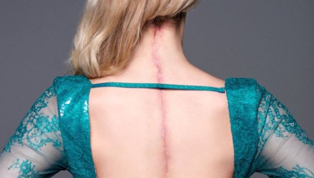 Una joven reina de la belleza muestra la cicatriz que recorre su espalda