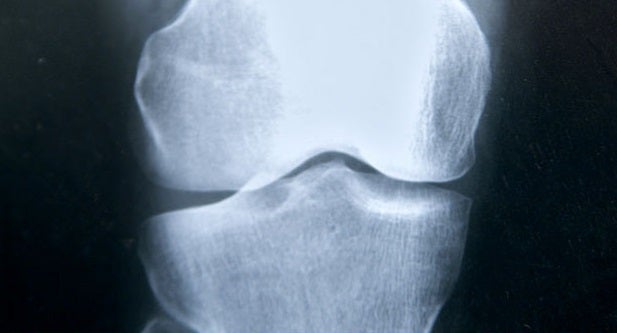 "Los nuevos fármacos para tratar la osteoporosis serán capaces de fabricar hueso nuevo" "Los nuevos fármacos para tratar la osteoporosis serán capaces de fabricar hueso nuevo"