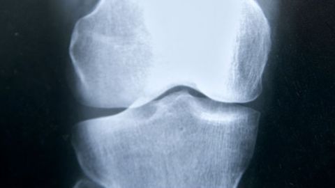 Una mutacion predispone a la fractura de femur en pacientes con osteoporosis