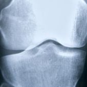 Una mutacion predispone a la fractura de femur en pacientes con osteoporosis