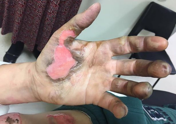 Una mujer sufre quemaduras de tercer grado después de que le explote su cigarrillo electrónico Una mujer sufre quemaduras de tercer grado después de que le explote su cigarrillo electrónico