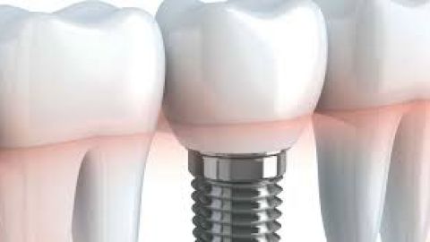Implantes dentales