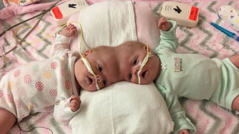 Siamesas unidas por la cabeza