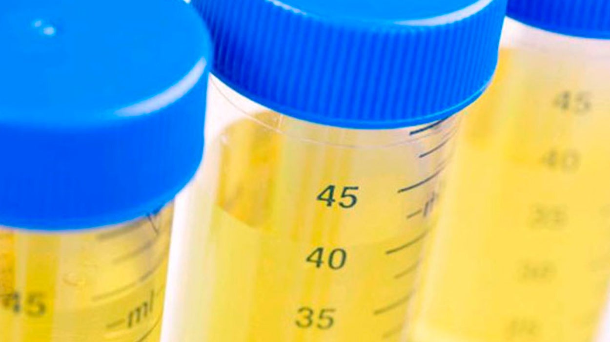 Cáncer de vejiga: así es la enfermedad que afecta a 22.300 españoles cada año Cáncer de vejiga: así es la enfermedad que afecta a 22.300 españoles cada año