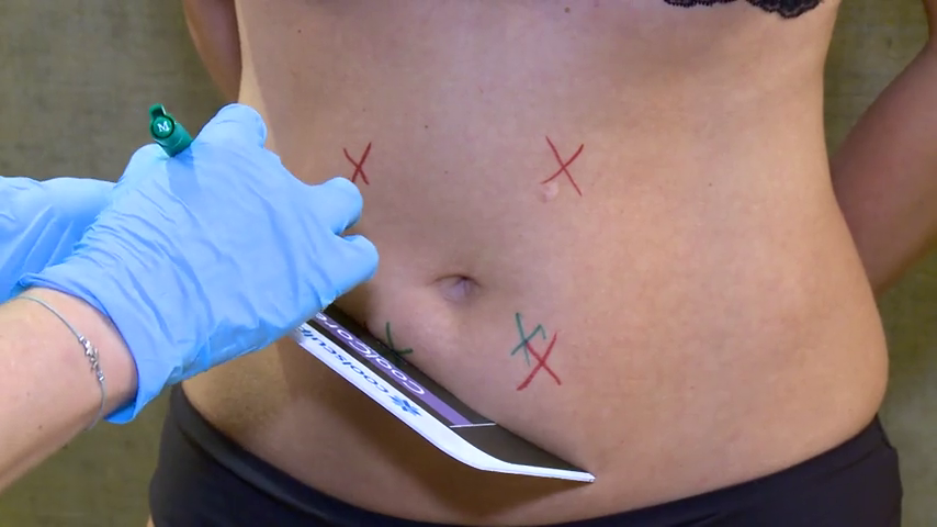 Defunció d'una dona ingressada un mes a l'UCI després de sotmetre's a una lipoescultura Defunció d'una dona ingressada un mes a l'UCI després de sotmetre's a una lipoescultura
