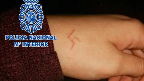 Imagen facilitada por la Policía Nacional de la esvástica que los ultras han grabado a fuego en la mano de la menor Imagen facilitada por la Policía Nacional de la esvástica que los ultras han grabado a fuego en la mano de la menor