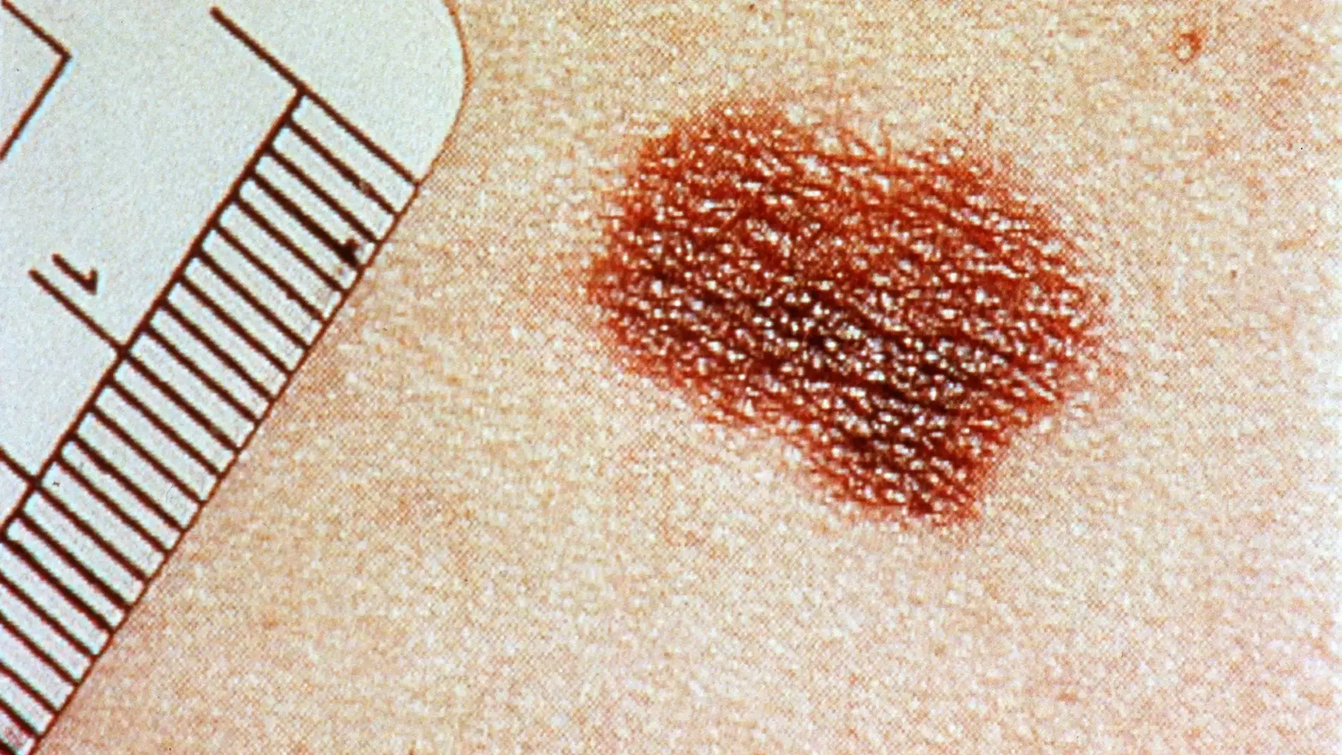 Melanoma Melanoma