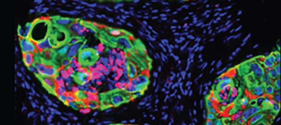 Un biomarcador predice que pacientes con cancer responderan mejor a la inmunoterapia Un biomarcador predice que pacientes con cancer responderan mejor a la inmunoterapia