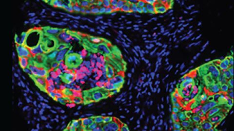 Un biomarcador predice que pacientes con cancer responderan mejor a la inmunoterapia