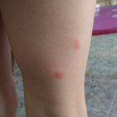 Picaduras de pulga en la pierna de un niño