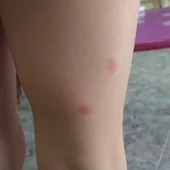 Picaduras de pulga en la pierna de un niño Picaduras de pulga en la pierna de un niño