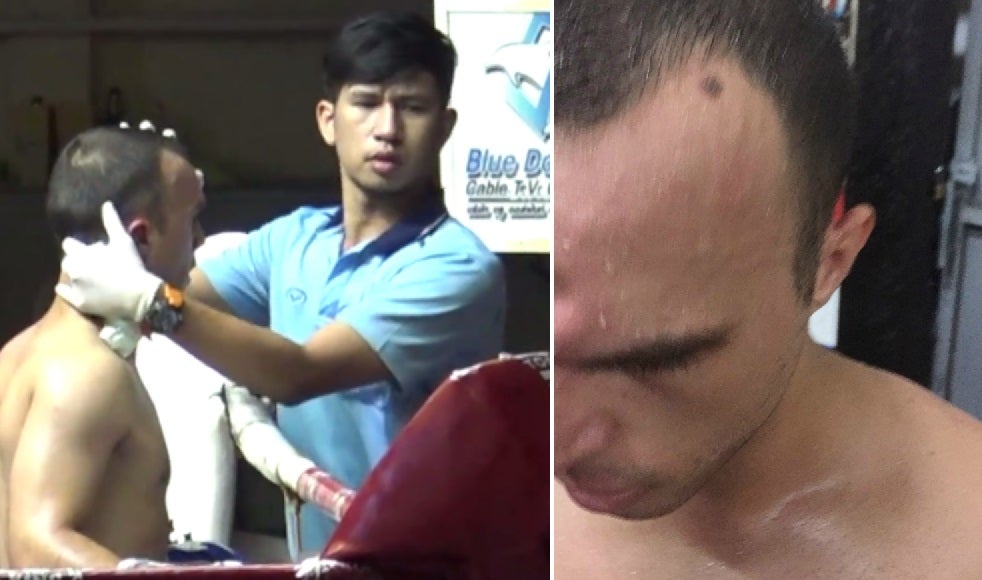 Duras imágenes: le hunden el hueso de la frente de un violento codazo Duras imágenes: le hunden el hueso de la frente de un violento codazo