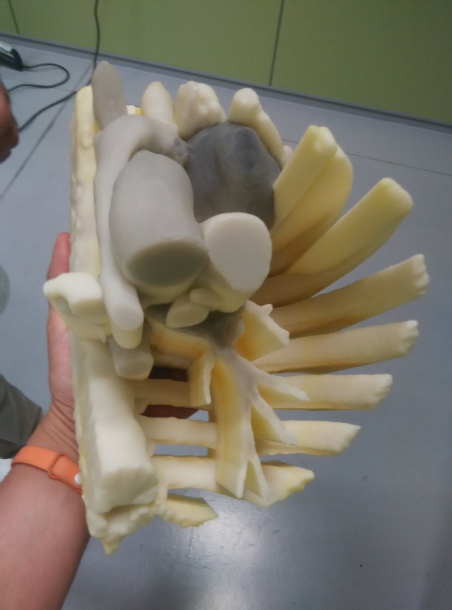 Fabrican en Jaén un modelo en 3D para facilitar la operación de un tumor en el pecho de una niña Fabrican en Jaén un modelo en 3D para facilitar la operación de un tumor en el pecho de una niña