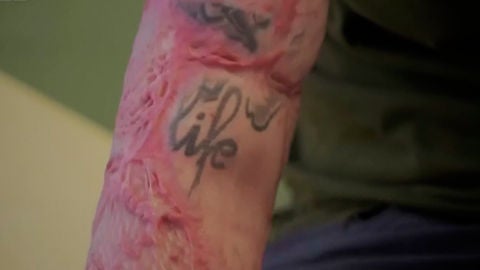 Un hombre se quema el 95% del cuerpo en una planta qu&iacute;mica y su hermano gemelo dona su piel para salvarle la vida