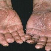 Las manos de un enfermo de lepra 