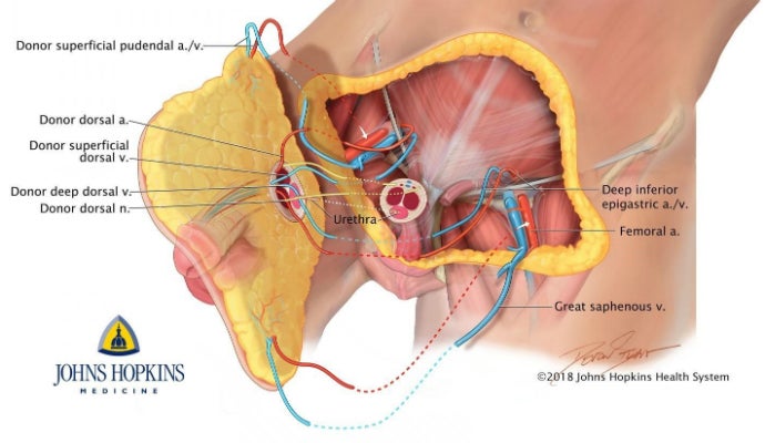 Realizan el primer trasplante total de pene y escroto en el mundo Realizan el primer trasplante total de pene y escroto en el mundo