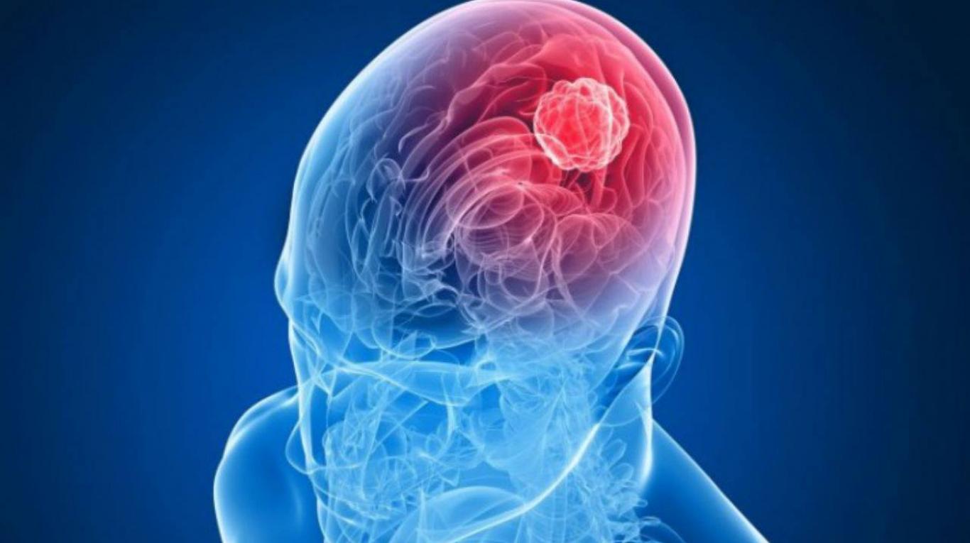 Prueban con éxito una inmunoterapia combinada que reduce las metástasis cerebrales de melanoma Prueban con éxito una inmunoterapia combinada que reduce las metástasis cerebrales de melanoma