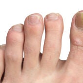 Hongos en las uñas de los pies