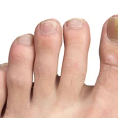 Hongos en las uñas de los pies Hongos en las uñas de los pies