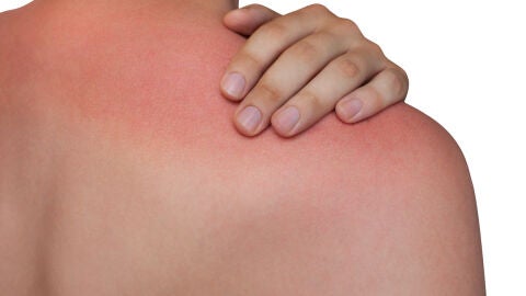 Quemadura solar en la espalda