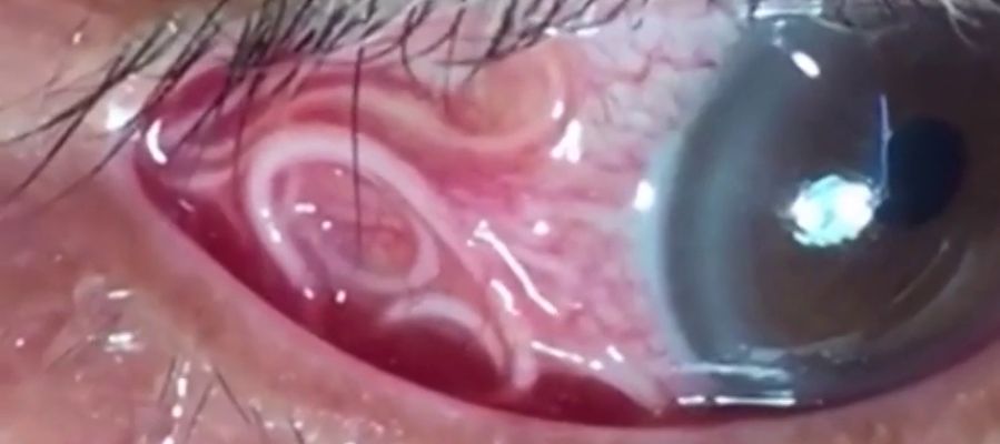 Las angustiosas imágenes que muestran la extracción de un gusano de 15 centímetros del ojo de un hombre Las angustiosas imágenes que muestran la extracción de un gusano de 15 centímetros del ojo de un hombre