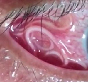 Las angustiosas imágenes que muestran la extracción de un gusano de 15 centímetros del ojo de un hombre Las angustiosas imágenes que muestran la extracción de un gusano de 15 centímetros del ojo de un hombre