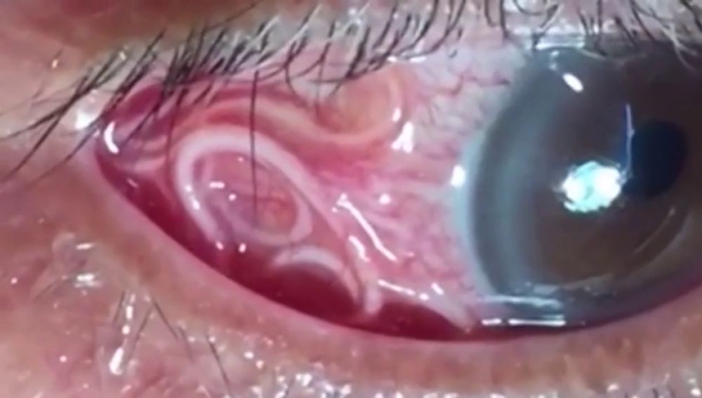 Las angustiosas imágenes que muestran la extracción de un gusano de 15 centímetros del ojo de un hombre