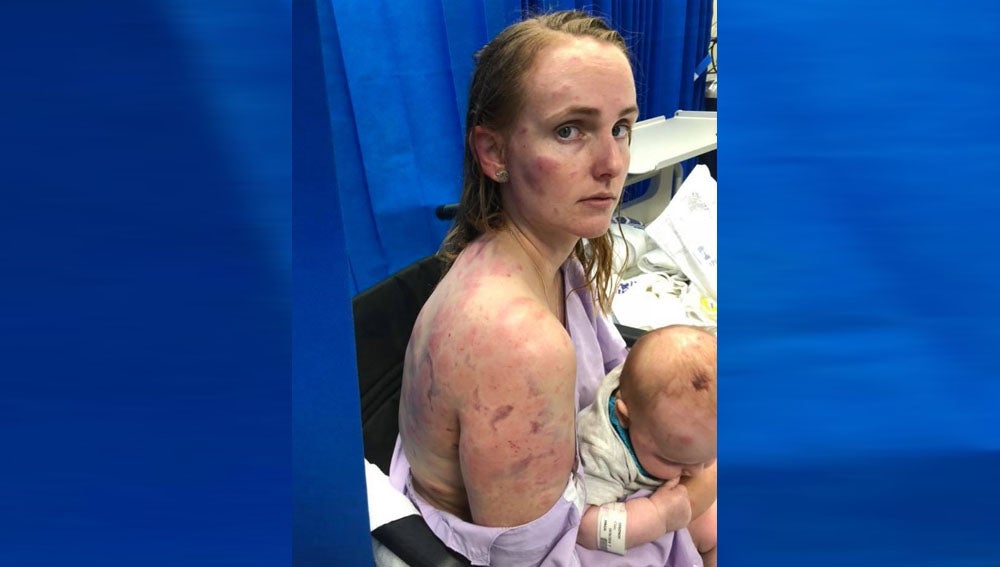 Una mujer resulta gravemente herida al proteger a su bebé de una fuerte tormenta de granizo Una mujer resulta gravemente herida al proteger a su bebé de una fuerte tormenta de granizo