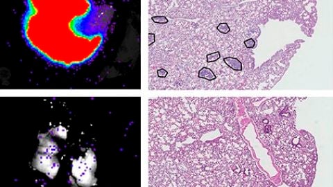 met&aacute;stasis de c&eacute;lulas de c&aacute;ncer de mama