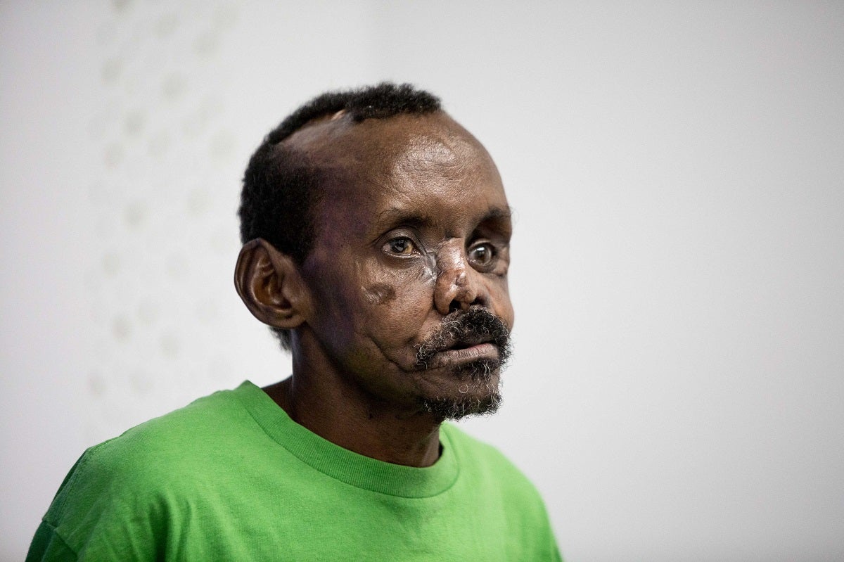 El cirujano Pedro Cavadas reconstruye el rostro y la mano de un keniano atacado por una hiena El cirujano Pedro Cavadas reconstruye el rostro y la mano de un keniano atacado por una hiena