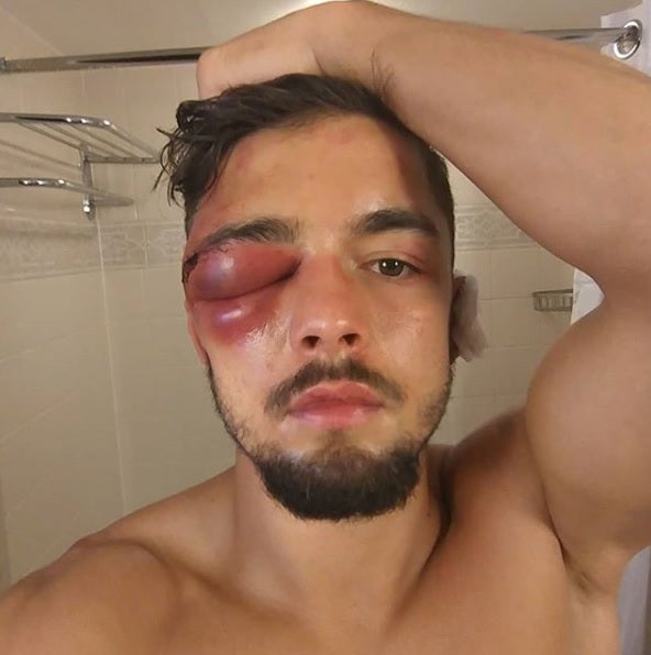 La terrible lesión en el ojo del boxeador Anthony Yigit que le obligó a retirarse de un combate La terrible lesión en el ojo del boxeador Anthony Yigit que le obligó a retirarse de un combate