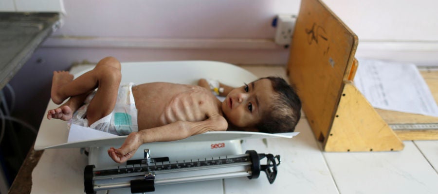 Un niño desnutrido en Yemen Un niño desnutrido en Yemen