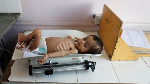 Un ni&ntilde;o desnutrido en Yemen