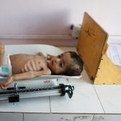 Un niño desnutrido en Yemen