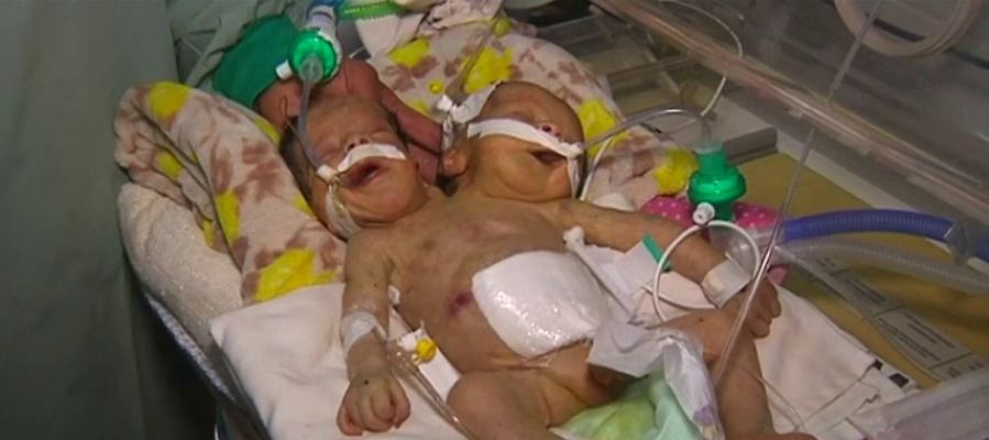 Los dos siameses de Yemen durante su estancia en el hospital Los dos siameses de Yemen durante su estancia en el hospital