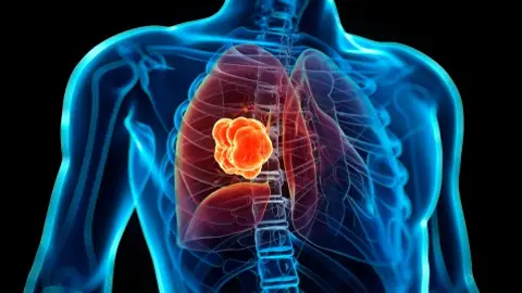Cáncer de pulmón Cáncer de pulmón