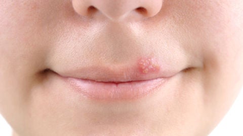Herpes labial