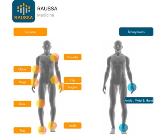Lanzan ‘Raussa’, la nueva aplicación para mejorar el diagnóstico de la artritis reumatoide Lanzan ‘Raussa’, la nueva aplicación para mejorar el diagnóstico de la artritis reumatoide