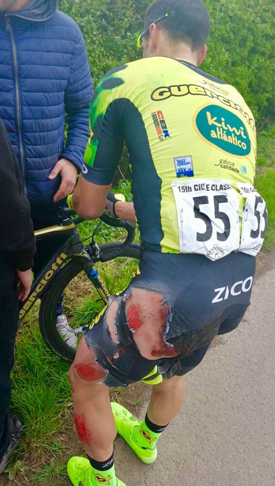 Estado en el que ha quedado el ciclista ilicitano José Carlos Núñez tras ser atropellado en Inglaterra.