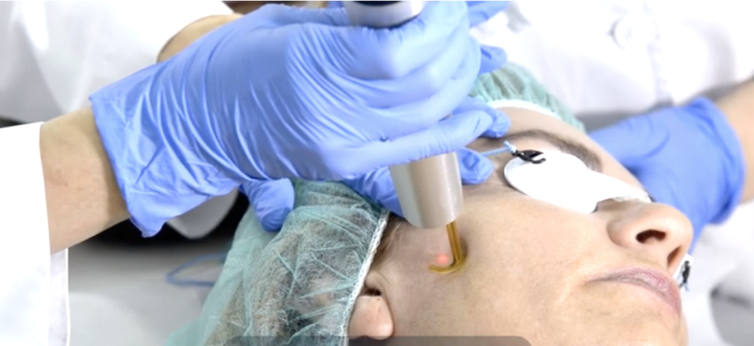 Los léntigos, manchas cutáneas benignas, pueden desaparecer con el tratamiento láser médico adecuado Los léntigos, manchas cutáneas benignas, pueden desaparecer con el tratamiento láser médico adecuado