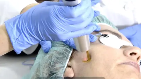 Unidad de Láser de pigmentos Léntigos