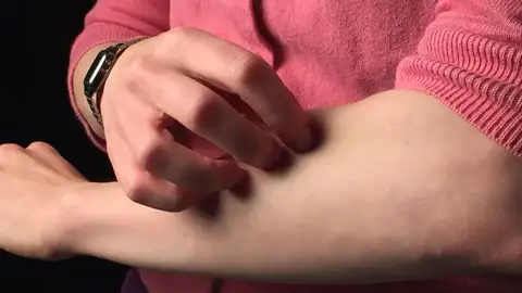 Lanzan ‘Psoriasis sin límites’, proyecto para explicar la enfermedad psoriásica y promover su detección precoz EN BUENAS MANOS