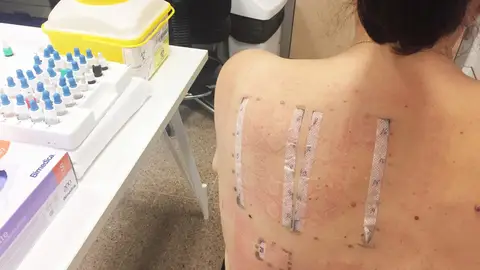 Prueba de alergia. Prueba de alergia.